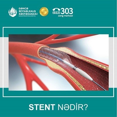 STENT NƏDİR?