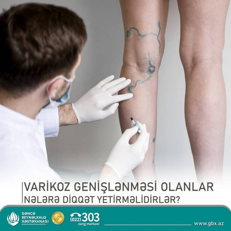 Varikoz Damar Genişlənməsi nədir?