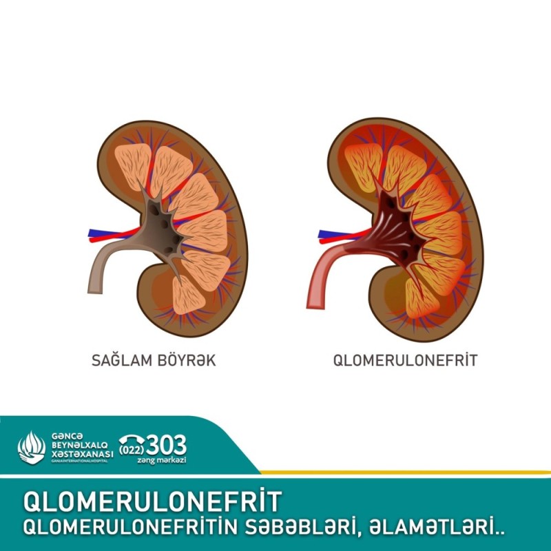 Qlomerulonefrit - səbəbləri , əlamətləri