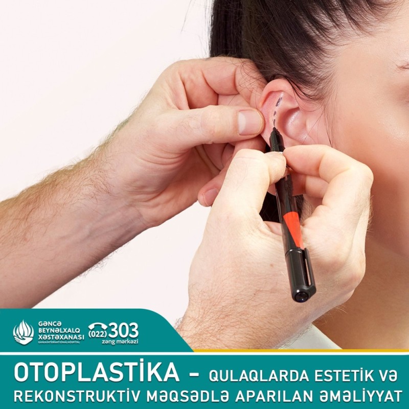 OTOPLASTİKA - qulaqlarda estetik və rekonstruktiv məqsədlə aparılan əməliyyat