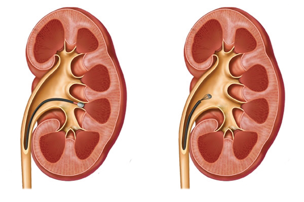 Retroqrad İntrarenal Cərrahiyyə