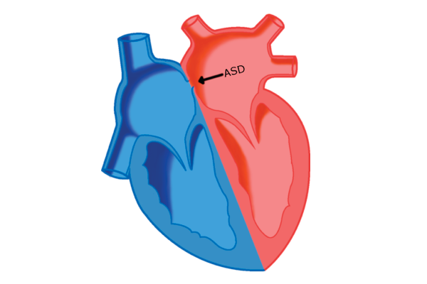 Atrial Septal Defekt