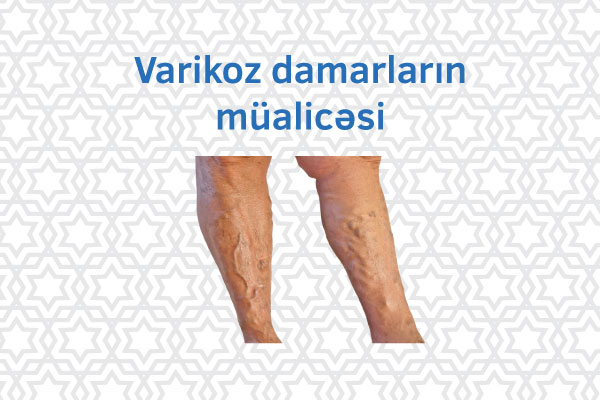 Varikoz damarlarının müalicəsi