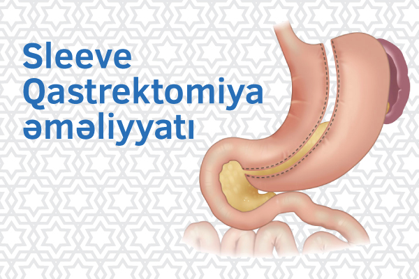 Arıqlamaq üçün Sleeve Qastrektomiya