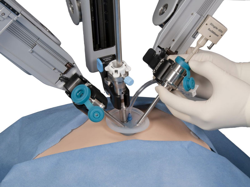 SİLS (Single Incision Laparoscopic Surgery)